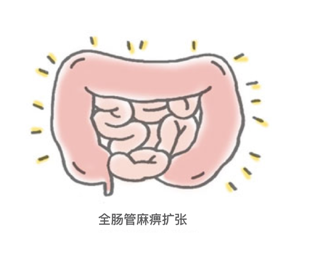 肠梗阻动画图片